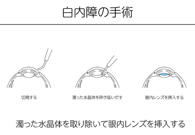 手術の流れ